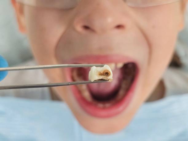 Best Emergency Wisdom Tooth Extraction in Channelview, TX